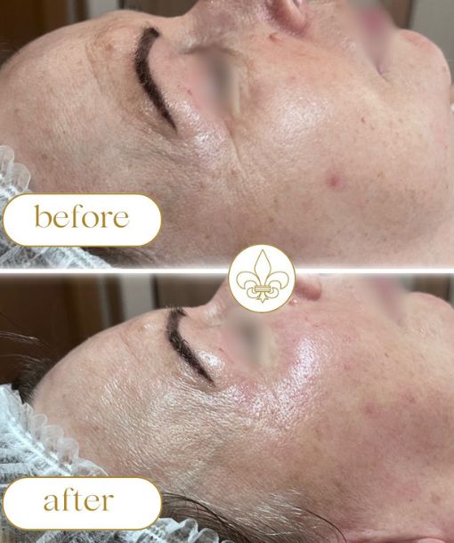 vital-age-line-mezoterapias-arcfiatalito-kezeles-sztella-esthetica-luxus-kozmetika-budapest-13.kerulet-jaszai-mari-ter-szalon Vital Age Line kezelés, skin booster, mikrotűs mezoterápiás arcfiatalítás, Vital Injector2, Genosys, prémium elektrokozmetikia kezelések, Juliette Armand, Sztella esthetica, ,szepsegszalon, budapest 13.kerulet, esztétikai kezelések