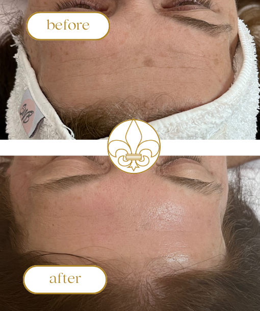 Genosys bio-meso pdrn expert kezelés, bio microneedling, spicula, hámlasztás, glass skin, pdrn, kollagéntermelés serkentése, arcfiatalítás, bőrfiatalítás, ránckezelés, pórusméret csökkentése, pdrn, peptidek, nukleotidok, anti-aging, innovatív arckezelések, sztella esthetica, luxus kozmetika, kozmetikus budapest, jászai mari tér, budapest 13. kerulet, szalon