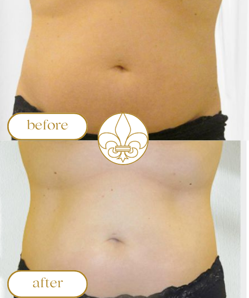 Liposonic HIFU tartos zsirbontas és feszesítés, testkezelés, zsírbontás, makacs zsírpárnák bontása, prémium kategóriás gépek, luxus kozmetika, esztétikai kezelések, innovatív kezelések, prémium géppark, budapest, 13.kerulet, jászai mari tér, szalon, kozmetikus budapest