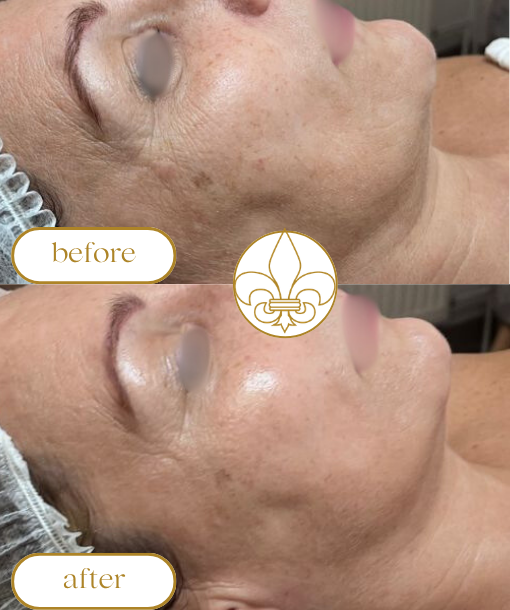PDRN Skin Booster kezelés, Skin Boooster, arcfiatalítás, ránctalanítás, bőrmegújító kezelés, Sztella esthetica, luxus kozmetika, innovatív arckezelések, mikrotűs mezoterápia, esztétikai szalon, kozmetika, budapest, 13. kerulet, jászai mari tér, szalon, kozmetikus budapest